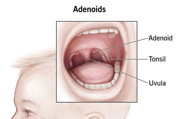 adenoidid