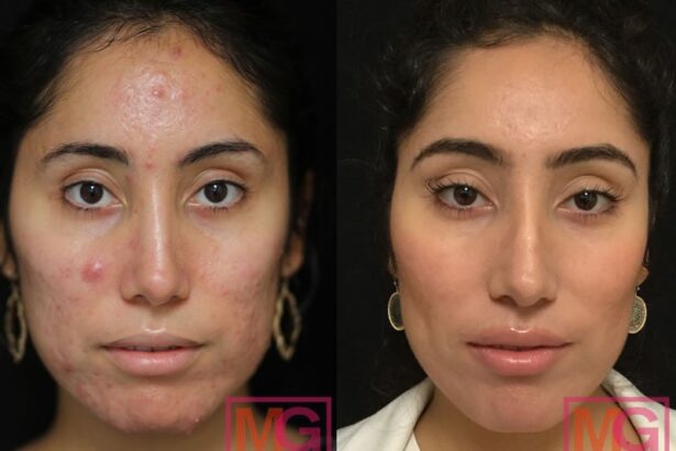 Accutane Before and After