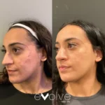 microneedling before and after