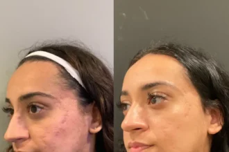 microneedling before and after